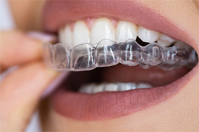 Aligners - Invisible Braces