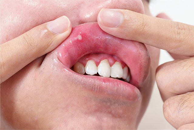 Mouth Ulcers Treatment