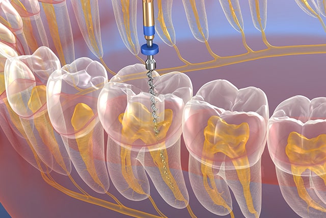 Root Canal Treatment (RCT)